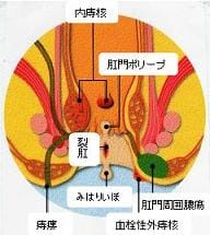 肛門疾患について