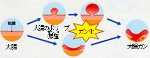 内視鏡検査・治療について：消化管腫瘍（良性腫瘍と悪性腫瘍）など